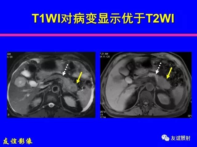 【PPT】肝胆胰脾常规MRI检查