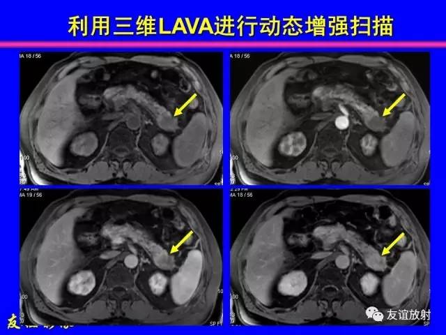【PPT】肝胆胰脾常规MRI检查