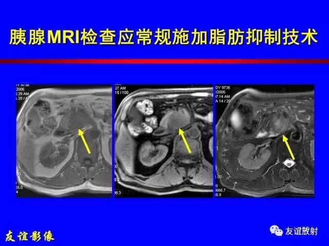 【PPT】肝胆胰脾常规MRI检查