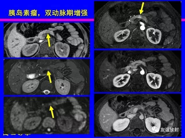 【PPT】肝胆胰脾常规MRI检查