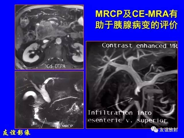 【PPT】肝胆胰脾常规MRI检查