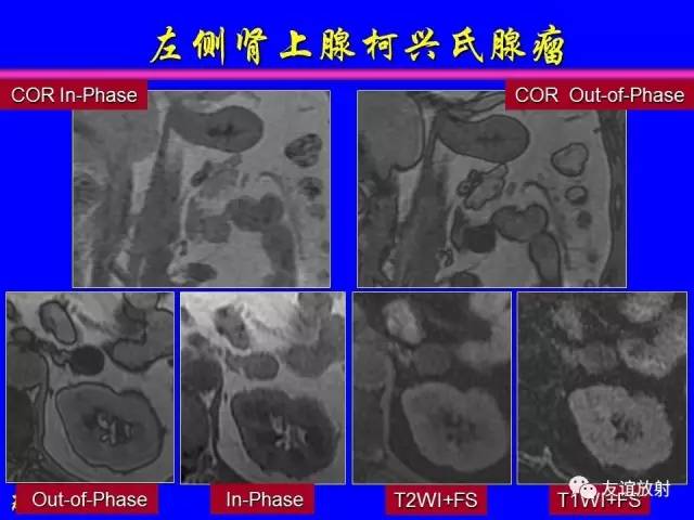 【PPT】肝胆胰脾常规MRI检查