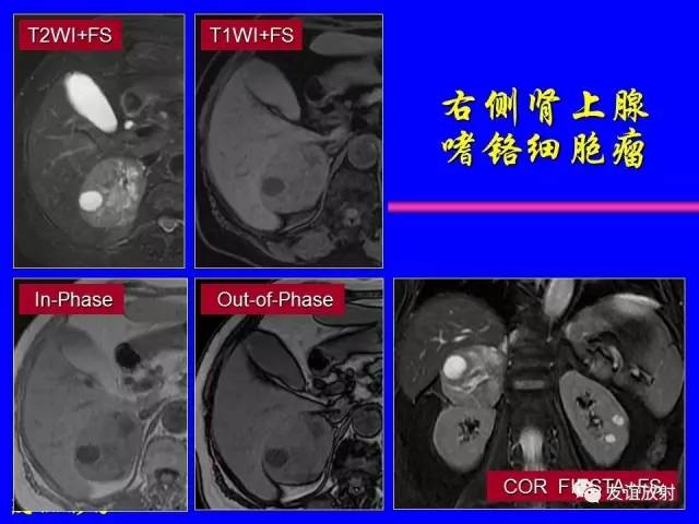 【PPT】肝胆胰脾常规MRI检查