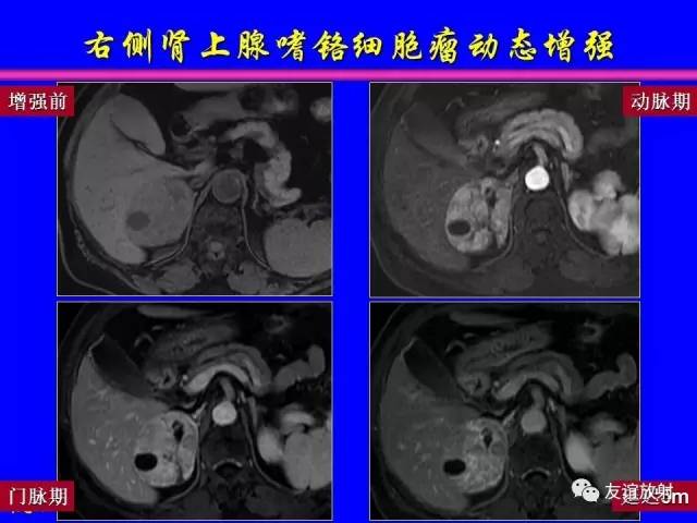 【PPT】肝胆胰脾常规MRI检查