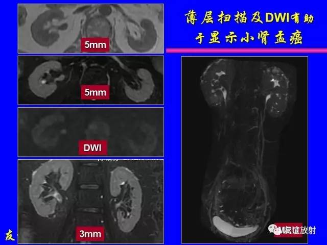 【PPT】肝胆胰脾常规MRI检查