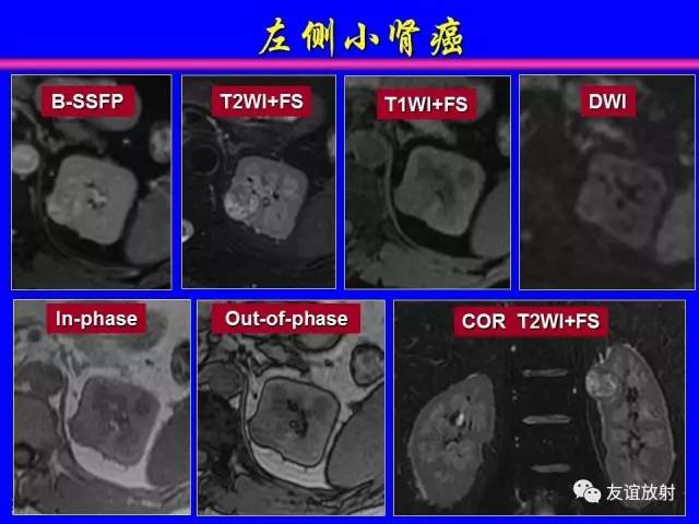 【PPT】肝胆胰脾常规MRI检查