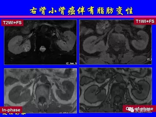 【PPT】肝胆胰脾常规MRI检查