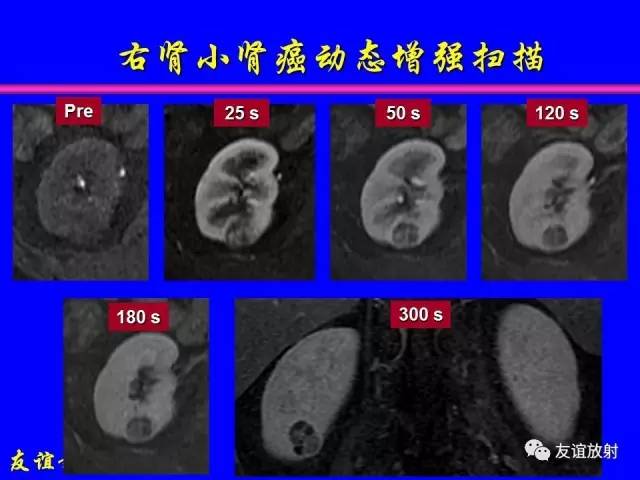 【PPT】肝胆胰脾常规MRI检查