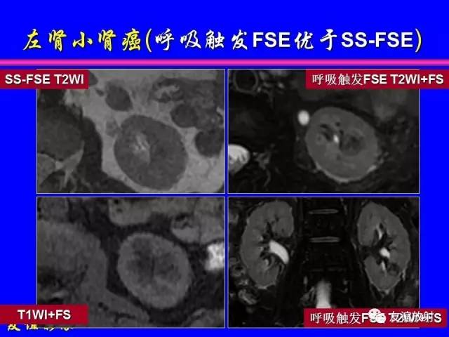 【PPT】肝胆胰脾常规MRI检查