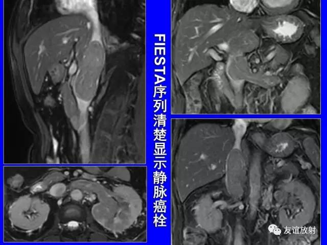 【PPT】肝胆胰脾常规MRI检查