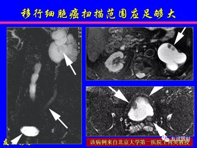 【PPT】肝胆胰脾常规MRI检查