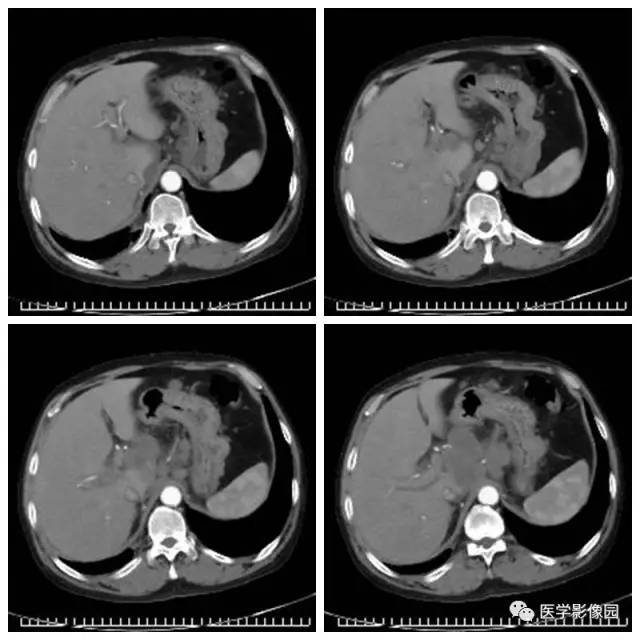 【病例】腹部淋巴瘤1例CT影像表现 【病例】腹部淋巴瘤1例CT影像表现