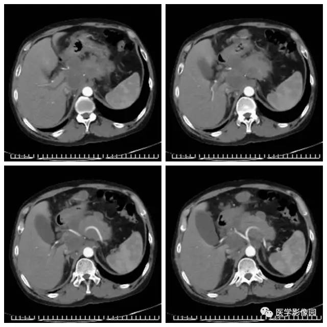 【病例】腹部淋巴瘤1例CT影像表现 【病例】腹部淋巴瘤1例CT影像表现