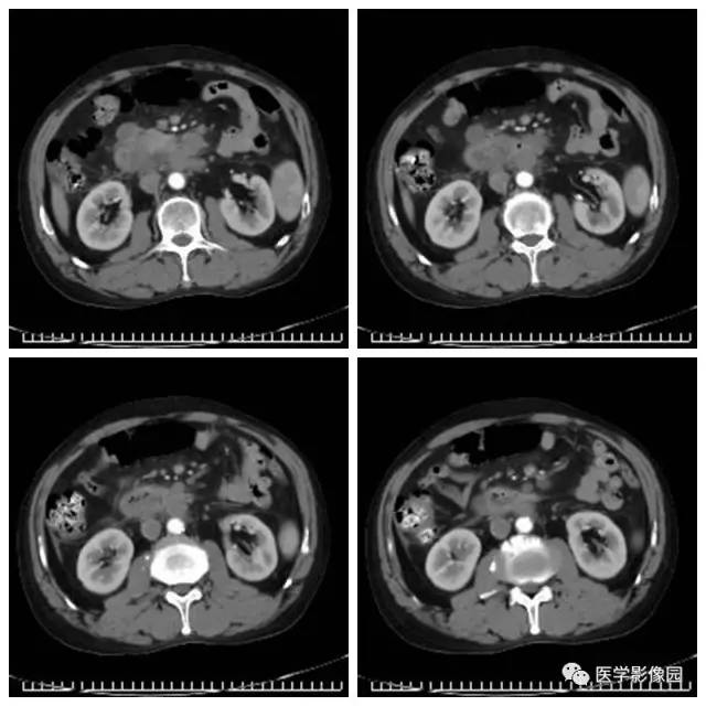 【病例】腹部淋巴瘤1例CT影像表现 【病例】腹部淋巴瘤1例CT影像表现