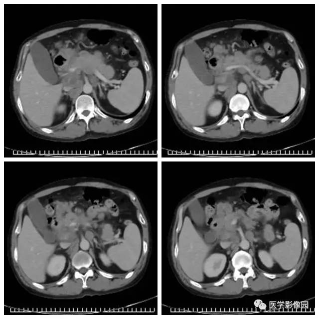 【病例】腹部淋巴瘤1例CT影像表现 【病例】腹部淋巴瘤1例CT影像表现