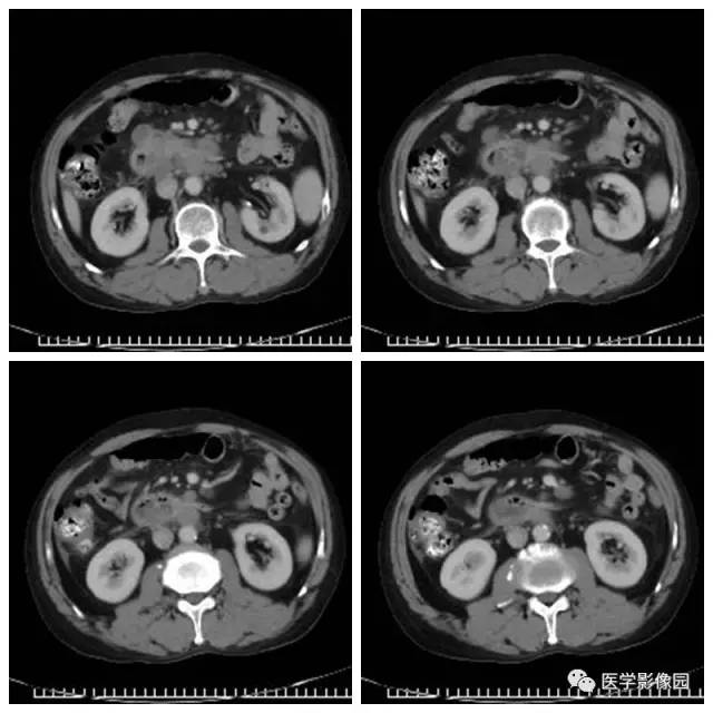 【病例】腹部淋巴瘤1例CT影像表现 【病例】腹部淋巴瘤1例CT影像表现