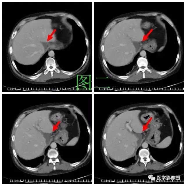 【病例】腹部淋巴瘤1例CT影像表现