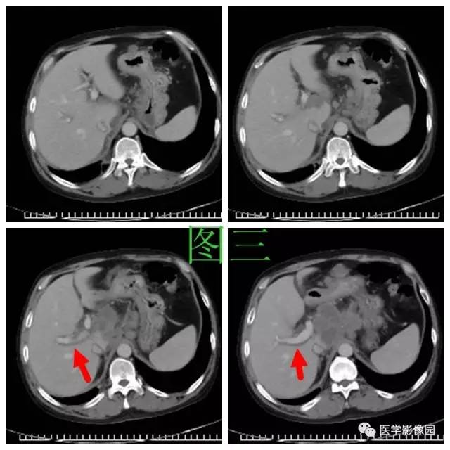 【病例】腹部淋巴瘤1例CT影像表现 【病例】腹部淋巴瘤1例CT影像表现