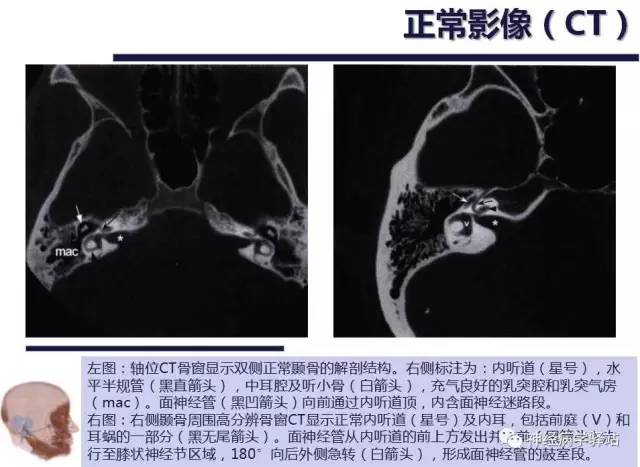 【PPT】面神经解剖、影像 【PPT】面神经解剖、影像