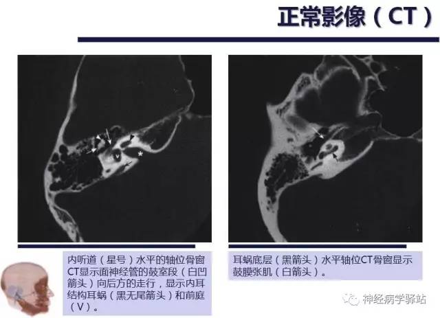 【PPT】面神经解剖、影像 【PPT】面神经解剖、影像