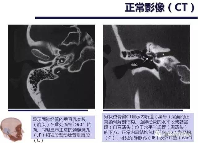 【PPT】面神经解剖、影像 【PPT】面神经解剖、影像