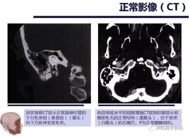 【PPT】面神经解剖、影像 【PPT】面神经解剖、影像