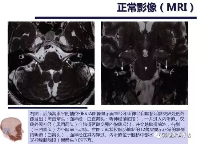 【PPT】面神经解剖、影像 【PPT】面神经解剖、影像