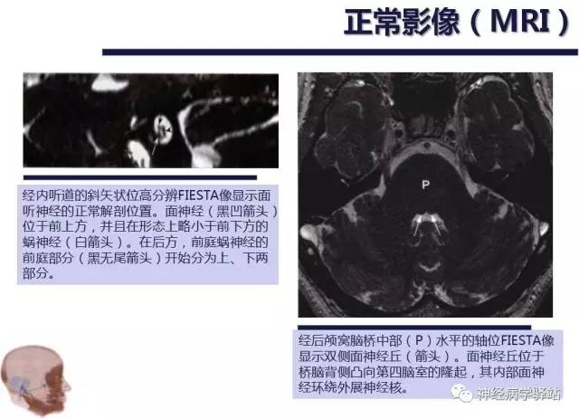 【PPT】面神经解剖、影像 【PPT】面神经解剖、影像