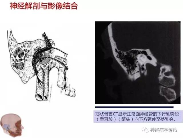 【PPT】面神经解剖、影像 【PPT】面神经解剖、影像