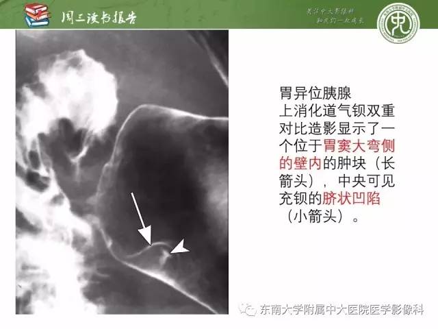 【PPT】异位胰腺：组织病理学，影像学特征及并发症