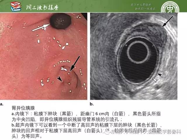 【PPT】异位胰腺：组织病理学，影像学特征及并发症