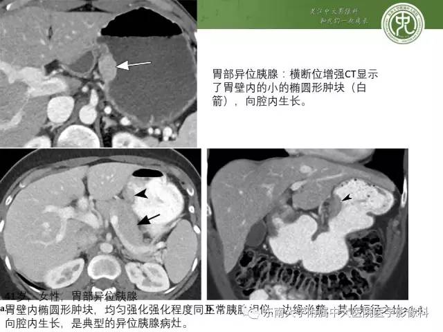 【PPT】异位胰腺：组织病理学，影像学特征及并发症