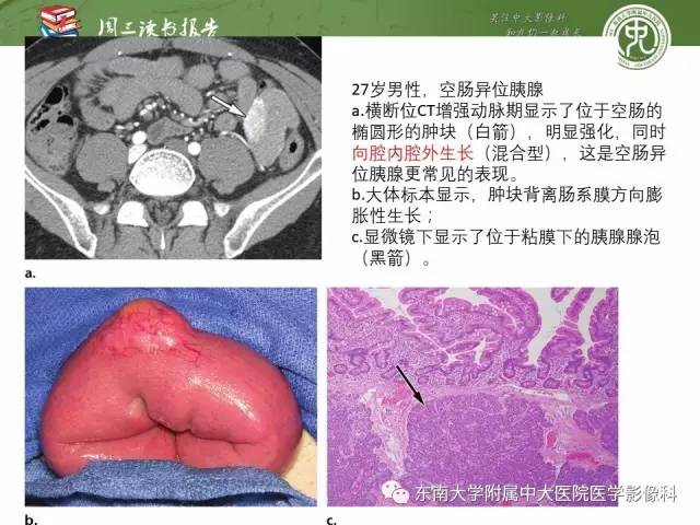 【PPT】异位胰腺：组织病理学，影像学特征及并发症
