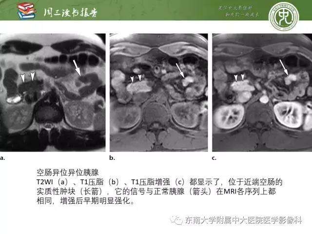 【PPT】异位胰腺：组织病理学，影像学特征及并发症