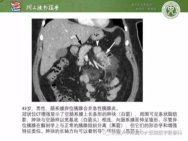【PPT】异位胰腺：组织病理学，影像学特征及并发症