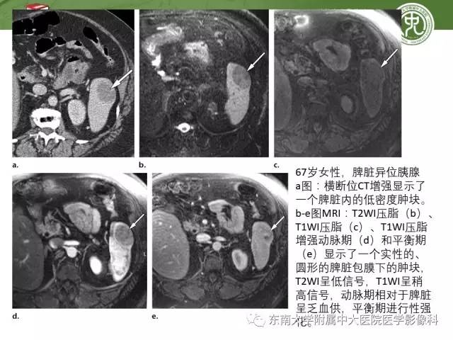 【PPT】异位胰腺：组织病理学，影像学特征及并发症