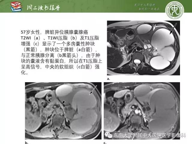 【PPT】异位胰腺：组织病理学，影像学特征及并发症