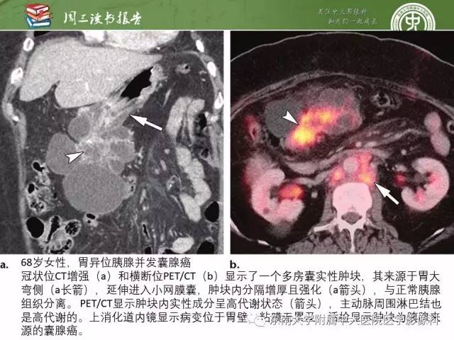 【PPT】异位胰腺：组织病理学，影像学特征及并发症
