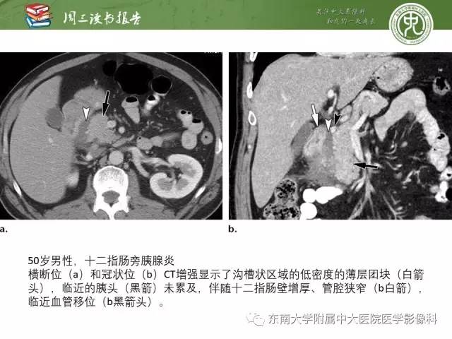【PPT】异位胰腺：组织病理学，影像学特征及并发症
