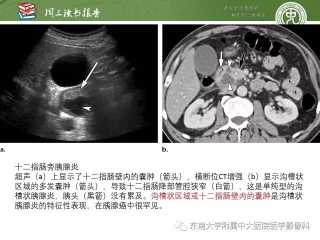 【PPT】异位胰腺：组织病理学，影像学特征及并发症