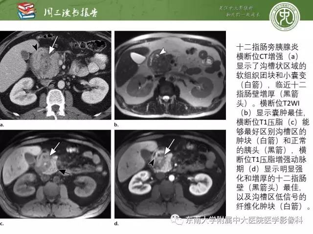 【PPT】异位胰腺：组织病理学，影像学特征及并发症