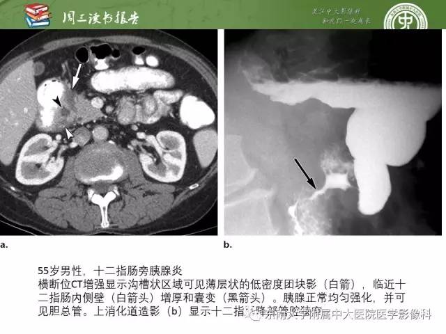 【PPT】异位胰腺：组织病理学，影像学特征及并发症