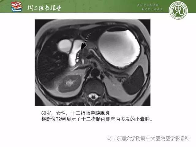 【PPT】异位胰腺：组织病理学，影像学特征及并发症