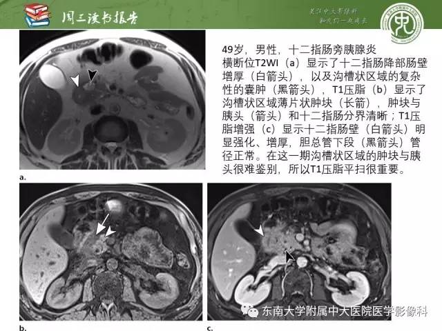 【PPT】异位胰腺：组织病理学，影像学特征及并发症