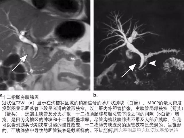 【PPT】异位胰腺：组织病理学，影像学特征及并发症