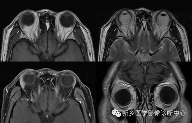 看到泪腺异常,要想到的9种疾病 看到泪腺异常,要想到的9种疾病