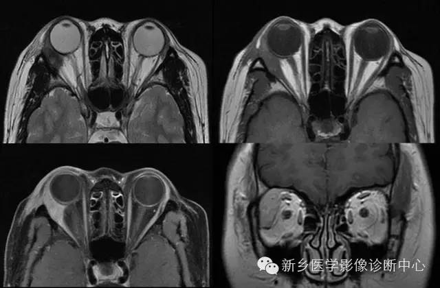 看到泪腺异常,要想到的9种疾病 看到泪腺异常,要想到的9种疾病