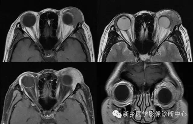 看到泪腺异常,要想到的9种疾病 看到泪腺异常,要想到的9种疾病