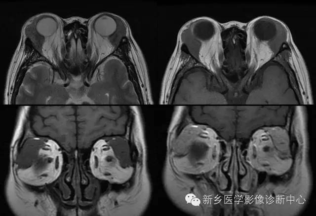 看到泪腺异常,要想到的9种疾病 看到泪腺异常,要想到的9种疾病