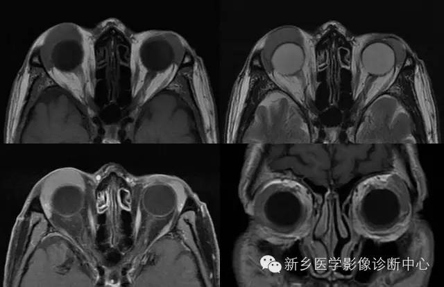 看到泪腺异常,要想到的9种疾病 看到泪腺异常,要想到的9种疾病